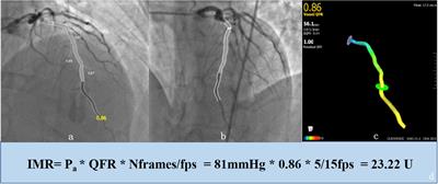 Association of endothelial glycocalyx shedding and <mark class="highlighted">coronary microcirculation</mark> assessed by an angiography-derived index of microcirculatory resistance in patients with suspected coronary artery disease